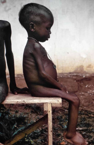 https://picryl.com/media/starved-girl-87adc1

Used with permission through Public Domain
